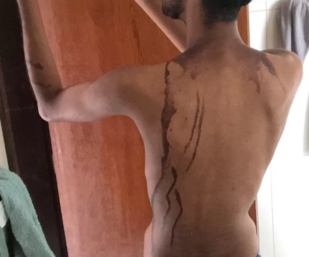 Aluno de 19 anos sofreu queimaduras na nuca e nas costas �- Foto: Reprodução
